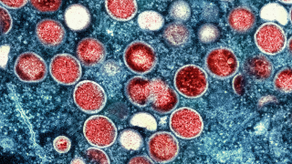 National Institute of Allergy and Infectious Diseases colorized transmission electron micrograph photograph of a monkeypox particles